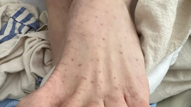 A foot with a rash.