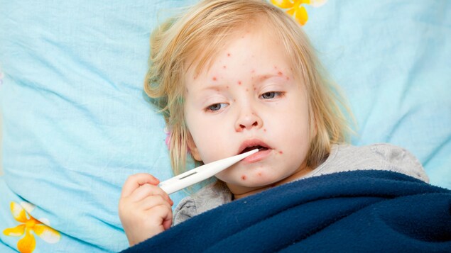 Une jeune fille au lit présente les symptômes de la rougeole.