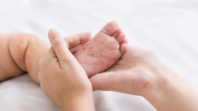 Deux mains tiennent le pied d'un bébé avec une éruption cutanée.