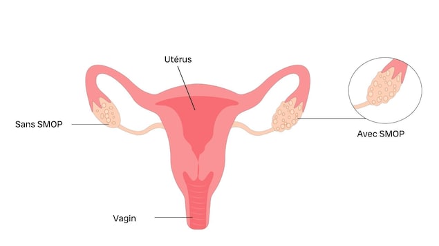 Présentation du système reproductif féminin avec un ovaire qui a le syndrome et l'autre non.