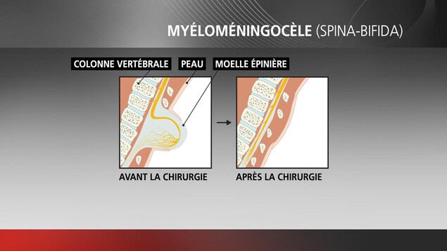 Après la chirurgie, la colonne vertébrale est droite et séparée du liquide amniotique. Après la chirurgie, la colonne vertébrale est droite et séparée du liquide amniotique.