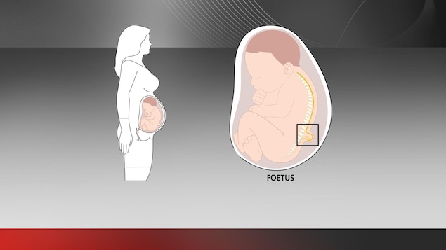 Une bosse apparaît dans le dos du foetus, où le liquide amniotique entre en contact avec la colonne vertébrale.