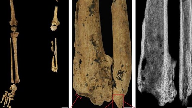 Image de la partie inférieure du squelette montrant l'absence d'une partie de la jambe gauche. 