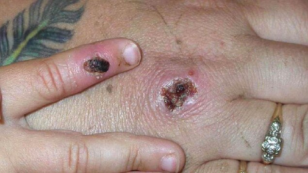 Symptômes d'un cas de la variole du singe détecté aux États-Unis en juin 2003. 