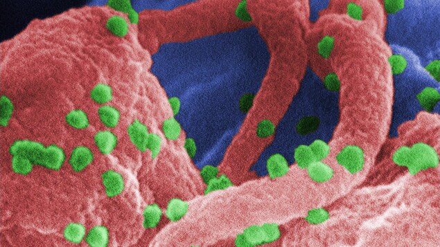 Le virus du VIH-1 (ici en vert) s'attaque aux lymphocytes du système immunitaire, tel que révélé par un microscope à balayage électronique. Le virus du VIH-1 (ici en vert) s'attaque aux lymphocytes du système immunitaire, tel que révélé par un microscope à balayage électronique.