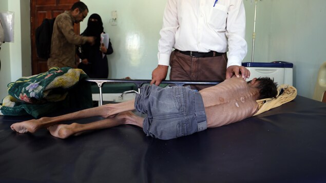 Un garçon couché est couché sur un lit, de dos, et il est si maigre que sa colonne vertébrale est particulièrement en évidence. 