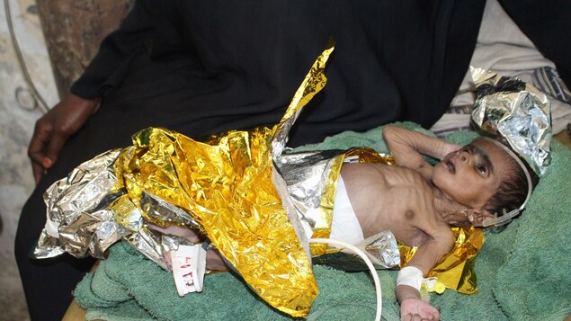 Un enfant maigre et entubé repose sur une table,