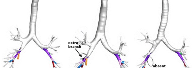 Illustration des types de variations pulmonaires. Illustration des types de variations pulmonaires.