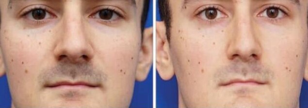 Des photos prises à 30 et 150 centimètres du visage. Des photos prises à 30 et 150 centimètres du visage.
