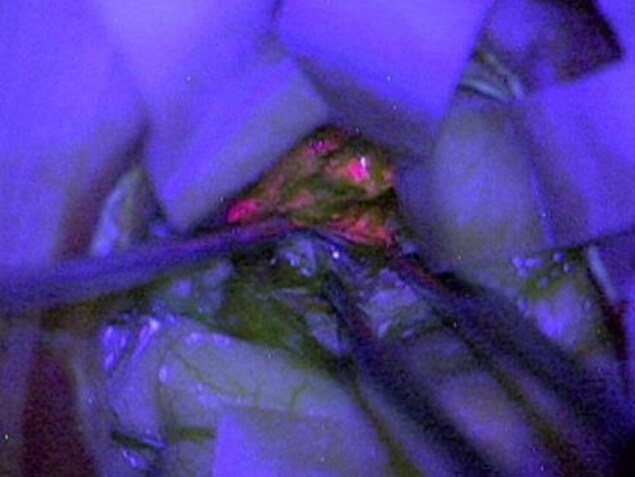 Un composé chimique qui fait briller les tumeurs cérébrales en rose. Un composé chimique qui fait briller les tumeurs cérébrales en rose.