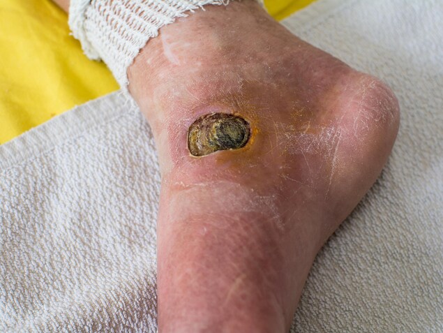 Plaie ouverte sur le pied d'une personne diabétique. Plaie ouverte sur le pied d'une personne diabétique.