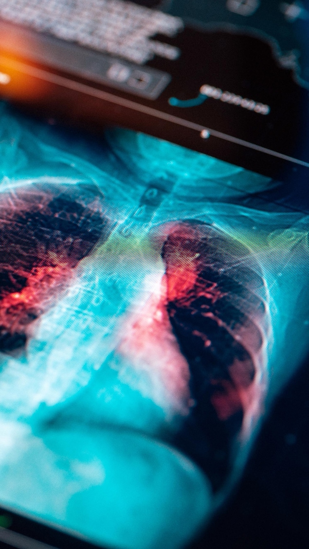 Rayon X d'un poumon atteint de cancer.