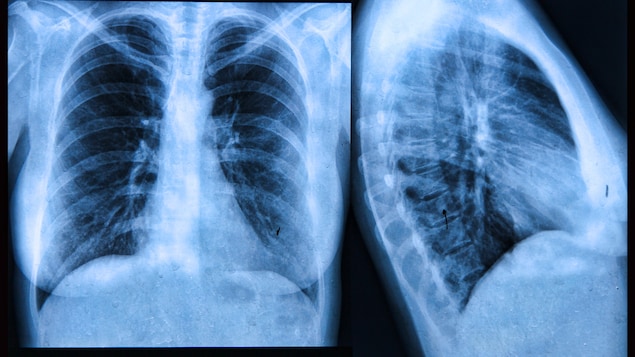 La fibrose kystique peut être dépistée grâce à la radiographie.