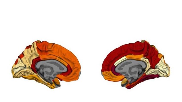 Comparaison de l’épaisseur du cortex entre les cerveaux de patients obèses et ceux de personnes atteintes de la maladie d’Alzheimer.