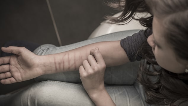 Une jeune fille se blesse le bras en se grattant de façon répétée.