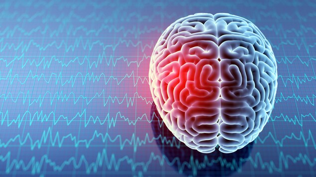 Un cerveau affecté par une commotion cérébrale.