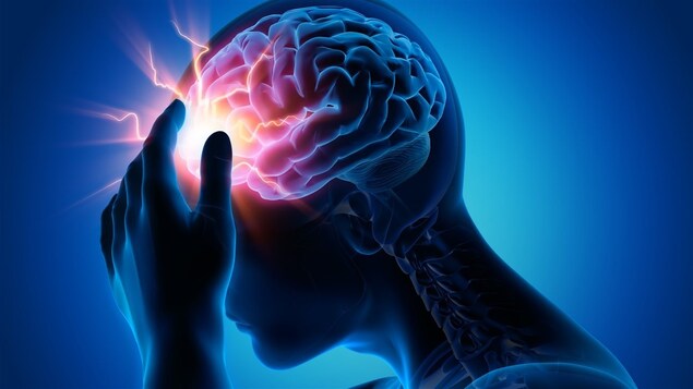 On voit un cerveau humain affecté par une commotion.