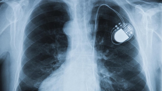 Une radiographie montre le stimulateur cardiaque d'un patient.