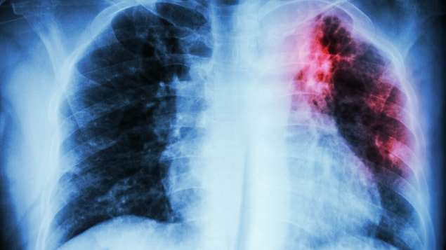 Une simple respiration pourrait transmettre la tuberculose, selon une étude