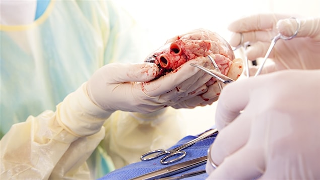 Dans une salle d'opération des mains gantées tiennent un coeur humain. 