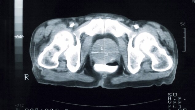 Une image rayon X sur laquelle on peut voir la prostate d'un patient