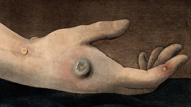 Une main d'un patient contaminé par la variole. 