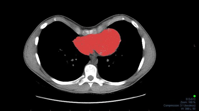 image en coupe de la cage thoracique qui montre comment une malformation du sternum compresse le coeur (coloré en rouge)  d'un patient 