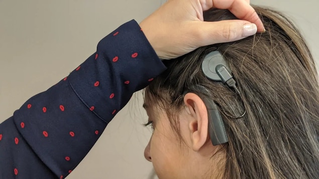 Un implant cochléaire positionné sur la tête d'une jeune fille.