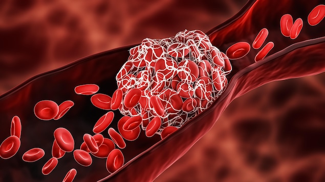 Illustration d'une thromboses.