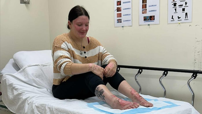 Laurie-Ann Savoie avec le visage, les mains et les pieds brûlés.