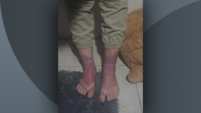 Des pieds brûlés en guérisoné