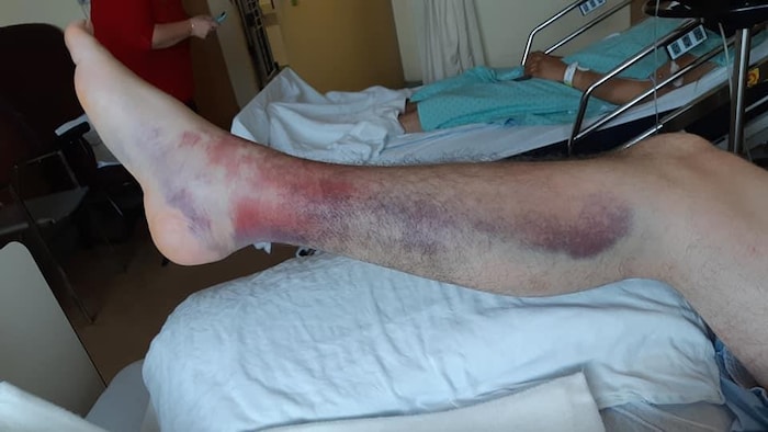 Bruises on the right calf of a man lying in a hospital bed.