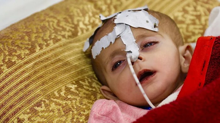 Afghanistan is seeing a rise in child malnourishment cases that some blame directly on the withdrawal of foreign aid after the Taliban victory in August.