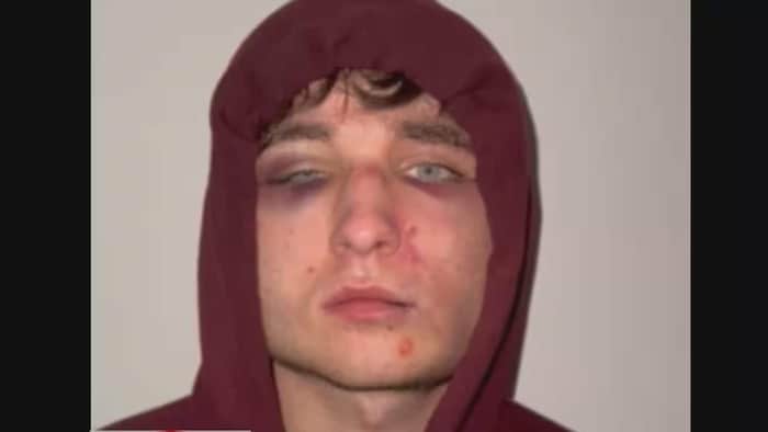 Aiden Pleterski au visage couvert d’ecchymoses.