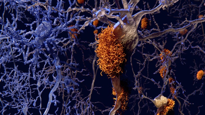 Illustration montrant des neurones présentant des plaques amyloïdes et des neurones sains (à gauche).