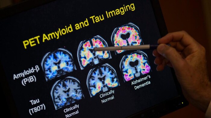 A doctor points to PET scan results.