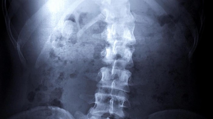 Una radiografía de una columna vertebral.