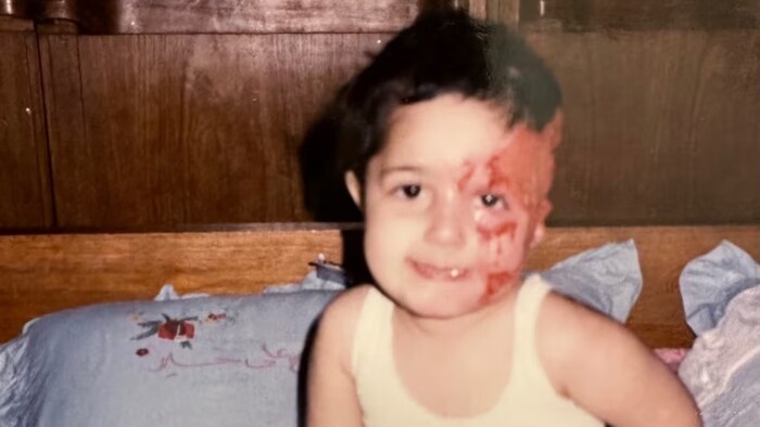 Hameed is shown at the age of two, after she was burned by hot oil in a kitchen accident in Iraq that left part of her face permanently scarred and made her a target for bullies. (Submitted by Basma Hameed)