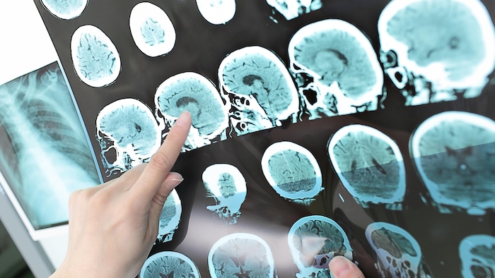 Images du cerveau d'un patient atteint de sclérose en plaques