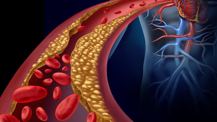 Illustration des ravages du mauvais cholestérol dans une artère.