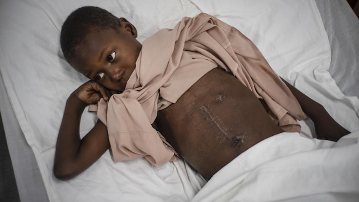 Un jeune garçon dans un lit montre une longue cicatrice sur son ventre.