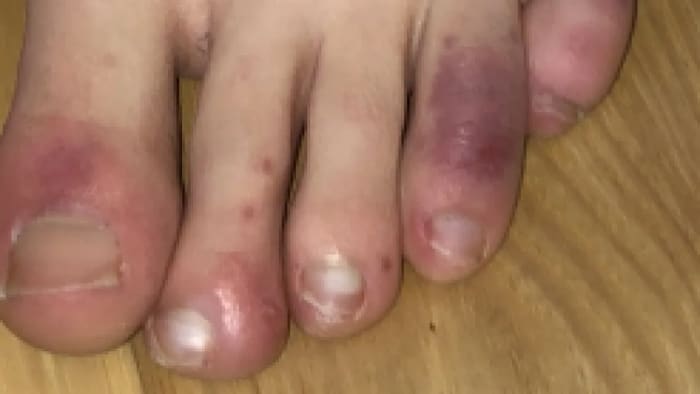 Les orteils décolorés d'un pied.