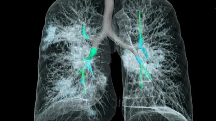 Une tomodensitométrie des poumons d'une personne atteinte de COVID-19. 