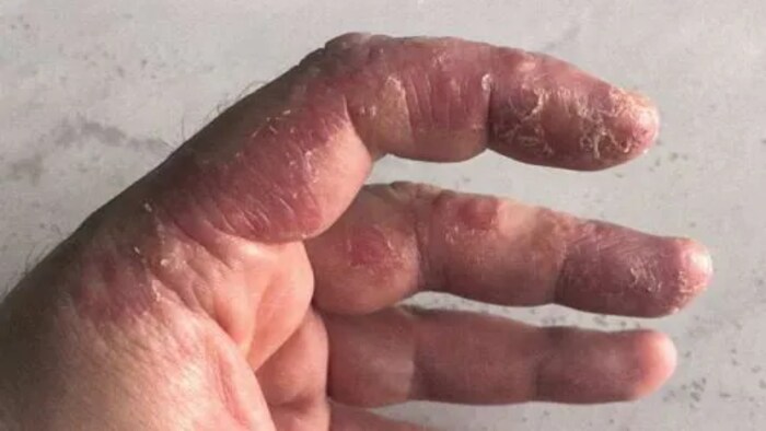 Ottawa allergist Antony Ham Pong described Otahbachi's condition as 'a severe blistering, weeping peeling eczematoid skin reaction,' and noted what 'appears to be a significant temporal relationship to receiving the vaccine and his skin symptoms.' (Submitted by Tisir Otahbachi)