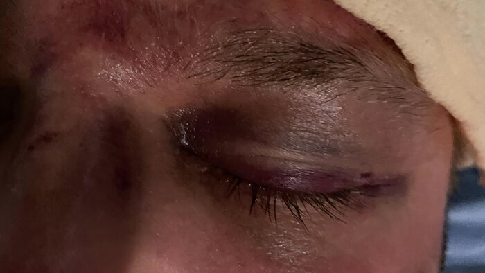 Gros plan des blessures.