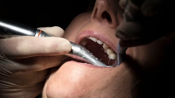 Gros program  d'un équipement dentaire dans la bouche d'une femme.