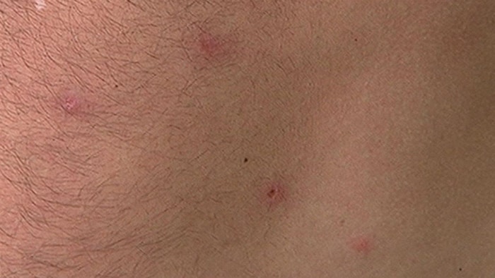 Les lésions causées par la dermatite du baigneur.