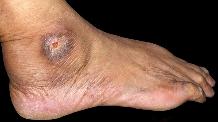Ulcère non cicatrisé dans la corne du pied.