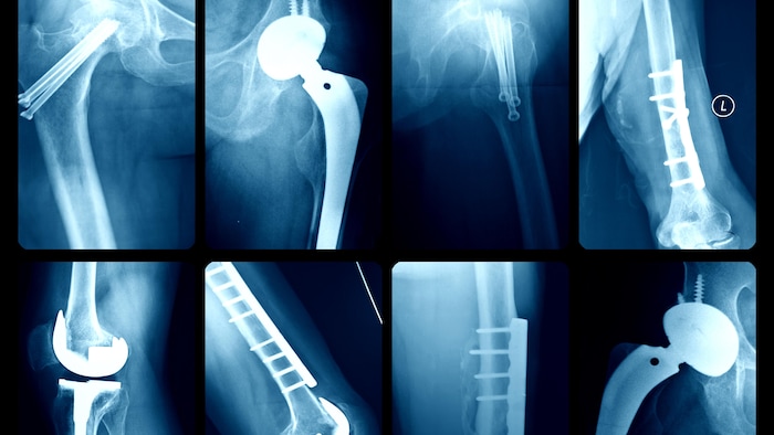 Des radiographies de dispositifs médicaux de la hanche et du genou.
