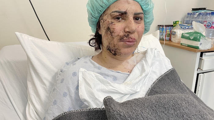 Une femme au visage criblé de débris de verre.